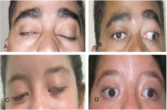 CAPV Optometria - Muitas doenças afetam a região dos olhos