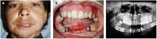 RBCP - Double free flap for oromandibular reconstruction