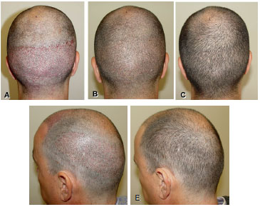 RBCP - Follicular unit extraction: hair transplant without linear scar