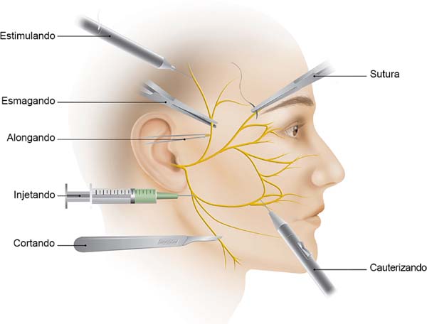 Causas de paralisis facial central pdf