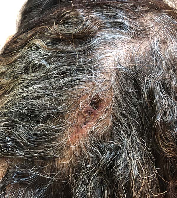RBCP - Proliferating isthmic-catagenic cystic follicular tumor in the scalp  or proliferating trichilemmal tumor: a case report