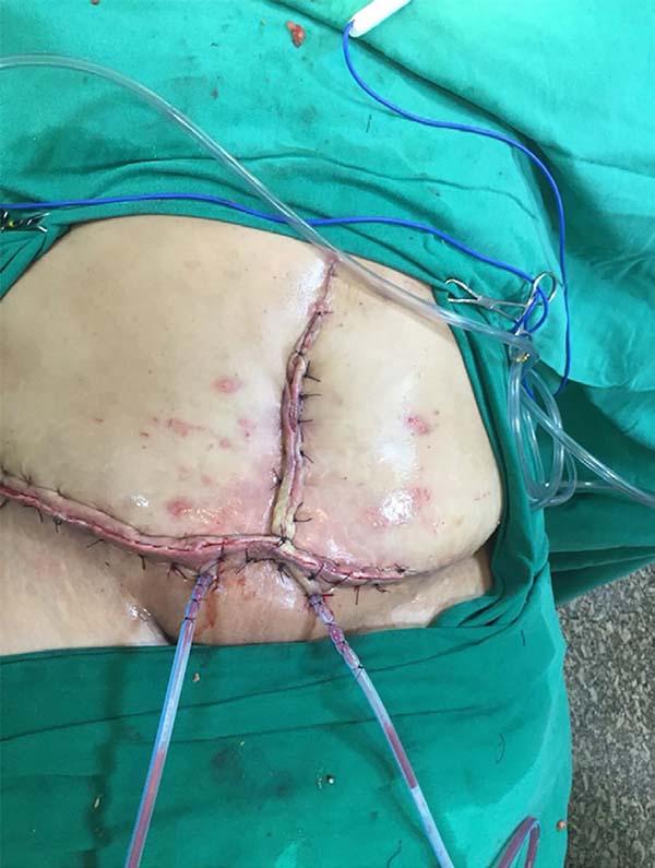 Cirurgia de hérnia e tratamento alternativo: lesão de Ferreira