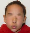 RBCP - Toxina botul\u00ednica para tratamento de s\u00edndrome do Choro ...