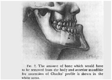 dinastia habsburgo Condição conhecida como prognatismo mandibular