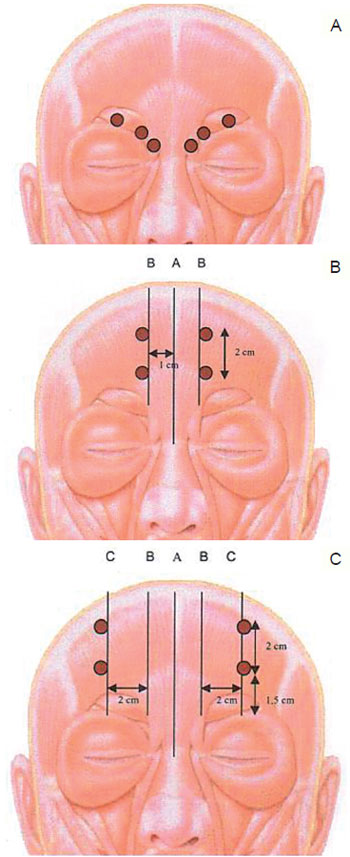 carruthers toxina botulinica pdf