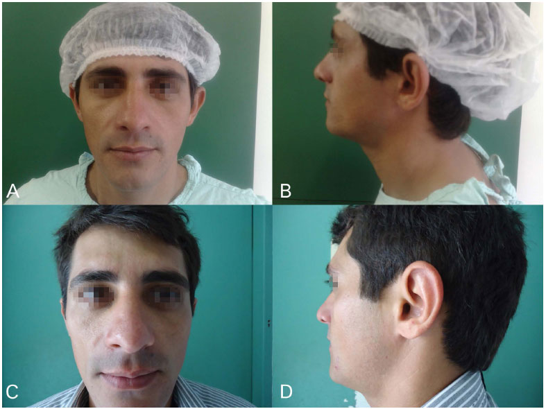 RBCP - Surgical correction of prominent ears: association of the Furnas and Mustardé techniques