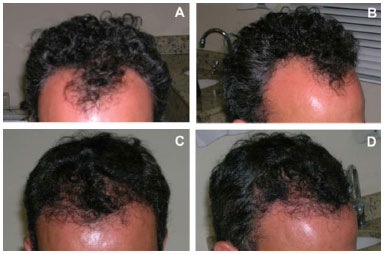 RBCP - Hair transplant of follicular units: a 15-case experience