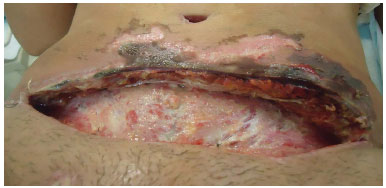 RBCP - Pioderma gangrenoso em abdominoplastia: relato de caso