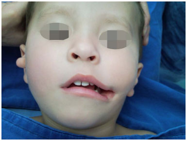 transverse facial cleft