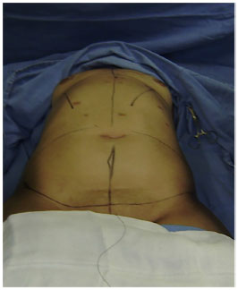 RBCP - Revisiting Postbariatric Monsplasty