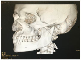 TRATAMENTO PARA Fratura Mandibular