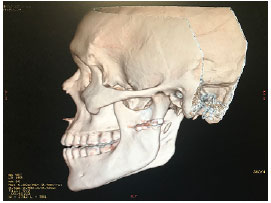 TRATAMENTO PARA Fratura Mandibular