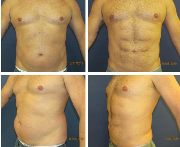 What Are the Different Types of Lipo in Frederick MD? - Hagerstown