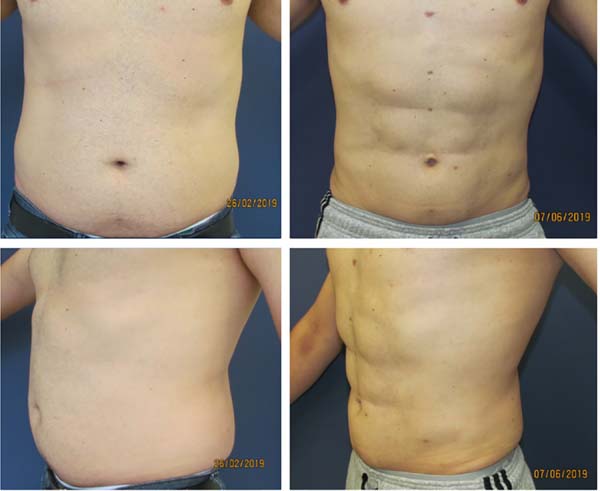 RBCP - Abdominal liposuction: evolving from high to medium definition