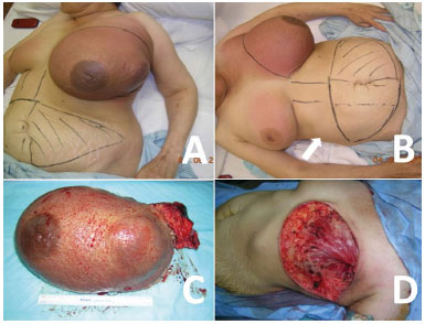 RBCP - Tensioned reverse abdominoplasty for reconstruction of large  post-mastectomy defects