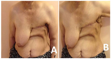 RBCP - Tensioned reverse abdominoplasty for reconstruction of large  post-mastectomy defects